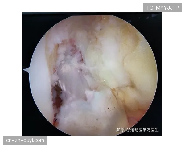 法兰克福后防中坚训练中韧带撕裂，康复期预计长达六个月